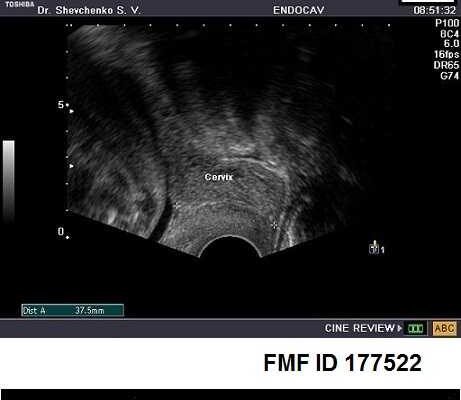 Цервікометрія при вагітності: норма, визначення та важливість діагностики