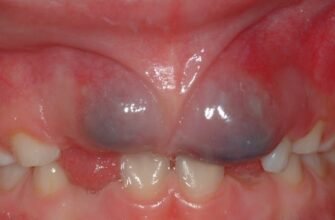 Симптоми та лікування флюсу у дитини: поради для батьків