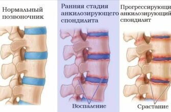 Хвороба Бехтерева МКБ 10: Симптоми, діагностика, лікування