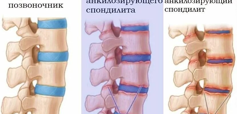 Хвороба Бехтерева МКБ 10: Симптоми, діагностика, лікування