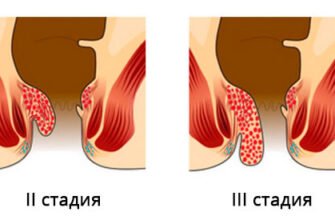 Геморой у дитини: причини, симптоми та ефективне лікування