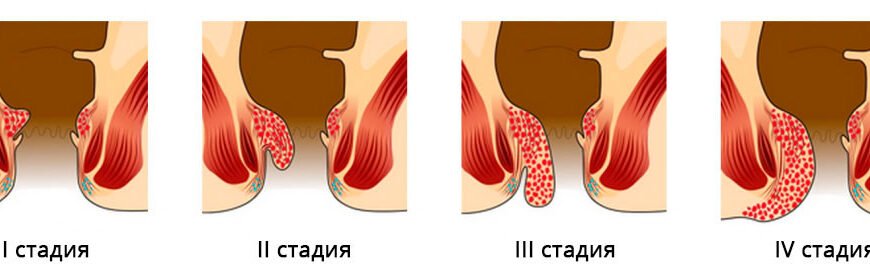 Геморой у дитини: причини, симптоми та ефективне лікування Геморой у дитини: причини, симптоми та ефективне лікування