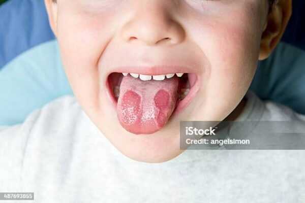 Географічний язик у дитини: причини, симптоми та лікування