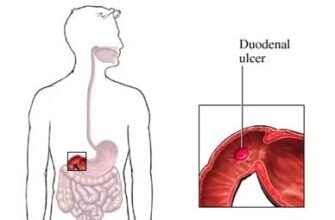 Виразкова хвороба 12 палої кишки: симптоми та ознаки захворювання