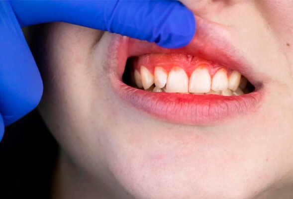 Гінгівіт у дитини 1 рік: ефективні методи лікування в домашніх умовах