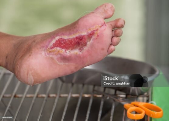 Рани на ногах при цукровому діабеті: фото, лікування та профілактика