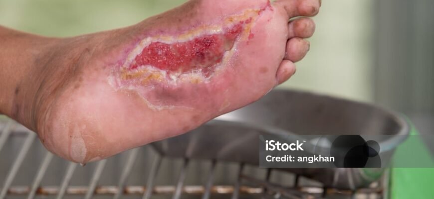 Рани на ногах при цукровому діабеті: фото, лікування та профілактика