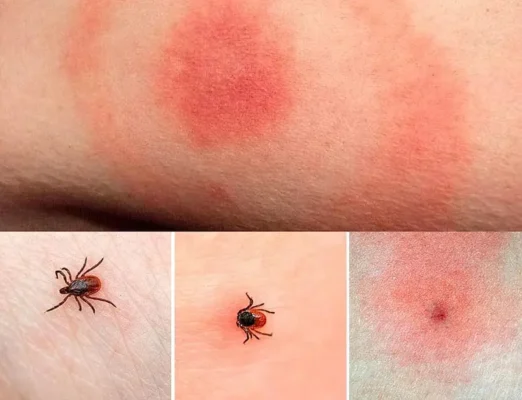 Що таке хвороба Лайма: симптоми, діагностика та лікування