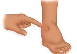 Набряк ніг при вагітності: причини, симптоми та способи полегшення