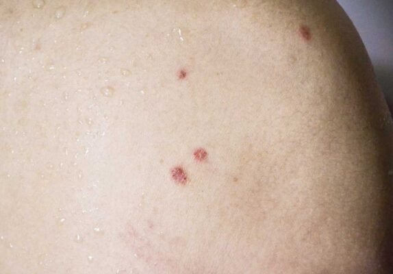 Хвороба Боуена: основні симптоми та методи діагностики