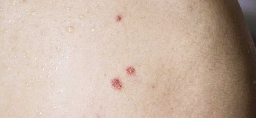 Хвороба Боуена: основні симптоми та методи діагностики