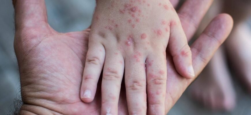 Висипка на ногах у дитини: причини, симптоми та лікування