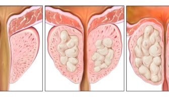 Фіброзні зміни передміхурової залози: причини, симптоми та лікування