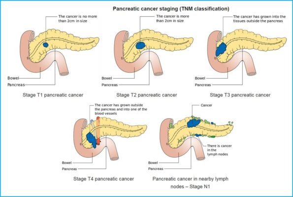 Реактивні зміни підшлункової залози: причини та ознаки