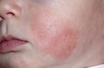 Висип на шкірі у дитини: причини, діагностика та лікування