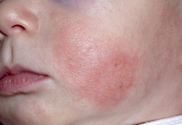 Висип на шкірі у дитини: причини, діагностика та лікування