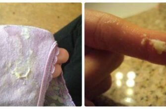 Виділення при молочниці: фото симптомів і ознаки захворювання