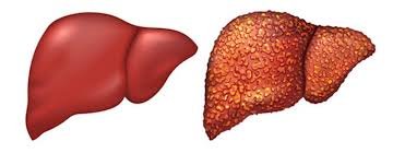 Симптоми жирової хвороби печінки: як вчасно виявити ризики?