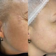 Чи можна колоти ботокс під очі: переваги, ризики та рекомендації