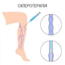 Варикозна хвороба вен нижніх кінцівок: класифікація та особливості