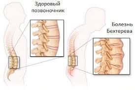 Хвороба Бехтерєва: отримання групи інвалідності в Україні