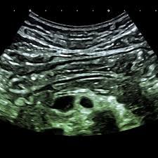 Виразкова хвороба шлунка і 12-палої кишки: симптоми, діагностика, лікування