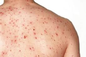 Хвороба Кір: Симптоми, Профілактика Та Лікування В Україні