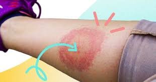 Хвороба Лайма: ефективні методи лікування та рекомендації лікарів