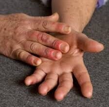 Лікування хвороби Рейно: хто лікує та як знайти фахівця?