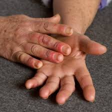 Лікування хвороби Рейно: хто лікує та як знайти фахівця?