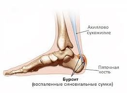 Ахіллесова п’ята хвороба: симптоми, діагностика та лікування