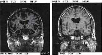 Гіпотрофічні зміни головного мозку: причини, симптоми та лікування
