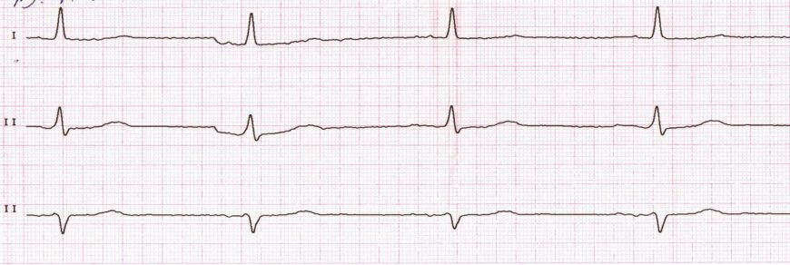 Дифузні зміни міокарда на ЕКГ: причини, діагностика та лікування
