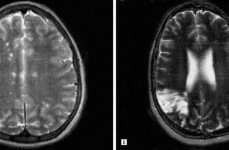 Гліозні зміни головного мозку: причини, симптоми та наслідки