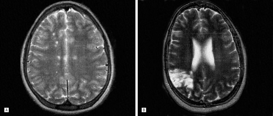 Гліозні зміни головного мозку: причини, симптоми та наслідки