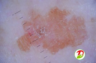 Хвороба Боуена: це стан шкіри, причини, симптоми та лікування