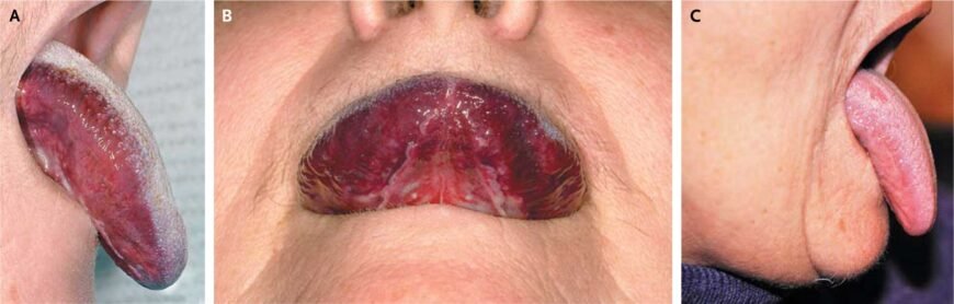 Що за хвороба, коли пече язик: основні причини і симптоми