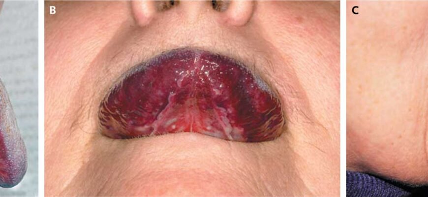 Що за хвороба, коли пече язик: основні причини і симптоми