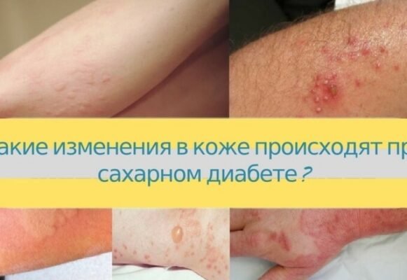 Висип при цукровому діабеті: фото, причини та лікування проблеми