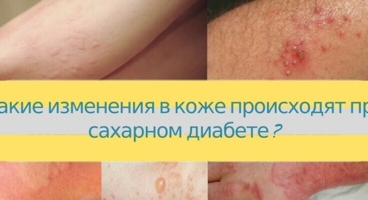 Висип при цукровому діабеті: фото, причини та лікування проблеми