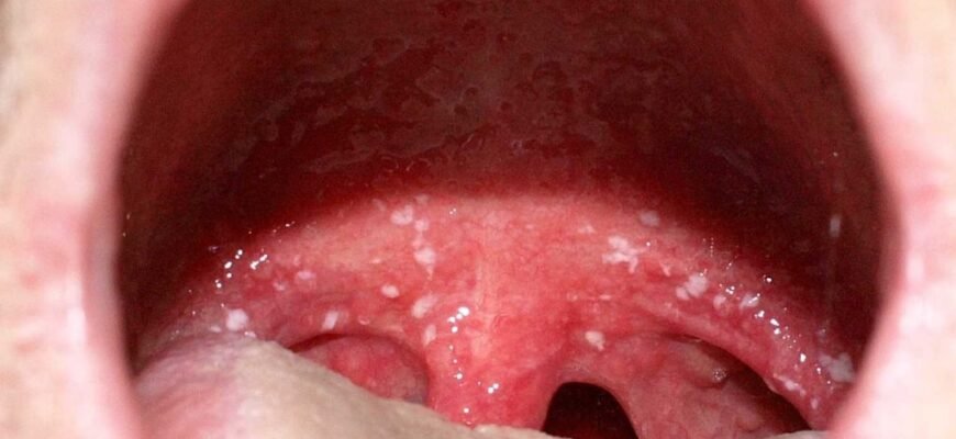 Ознаки та профілактика інфекцій горла: поради для здоров’я