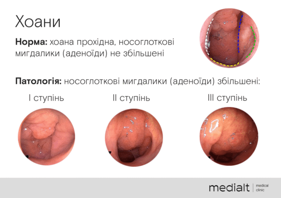 Реабілітація після видалення аденоїдів у дитини: поради та етапи процесу