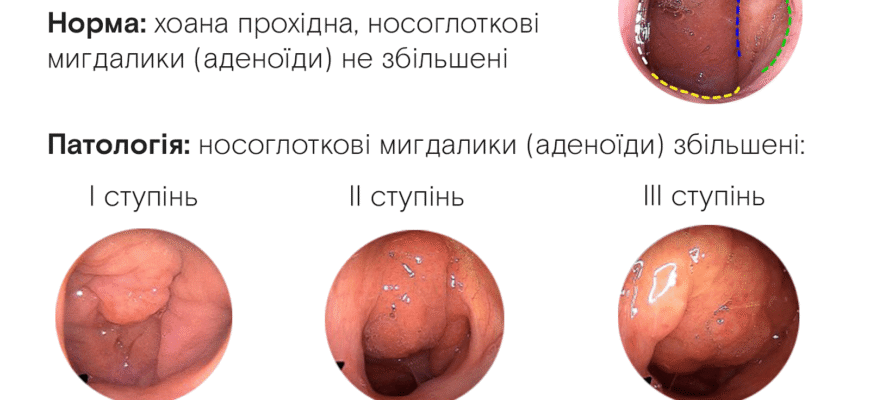 Реабілітація після видалення аденоїдів у дитини: поради та етапи процесу Реабілітація після видалення аденоїдів у дитини: поради та етапи процесу