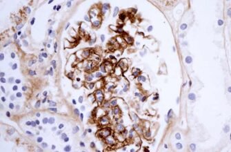 Хвороба Берже: симптоми, діагностика та сучасні методи лікування Хвороба Берже: симптоми, діагностика та сучасні методи лікування