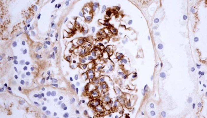 Хвороба Берже: симптоми, діагностика та сучасні методи лікування