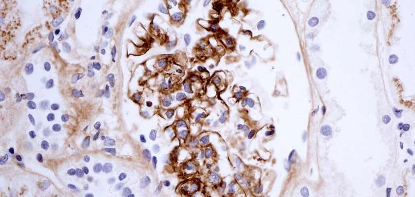 Хвороба Берже: симптоми, діагностика та сучасні методи лікування Хвороба Берже: симптоми, діагностика та сучасні методи лікування