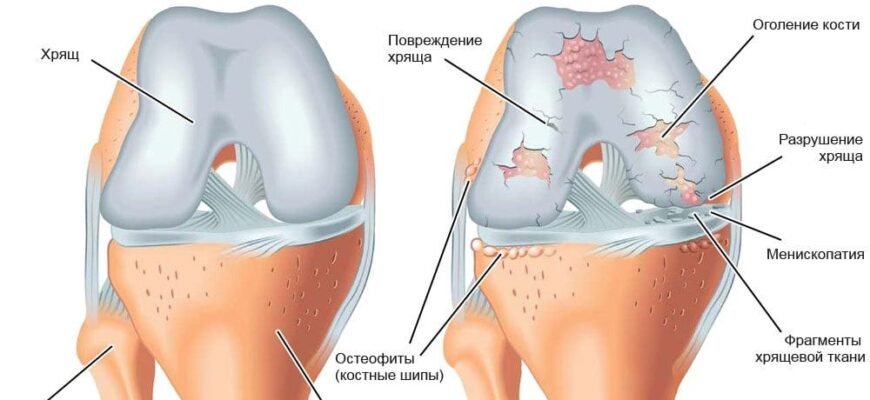 Хвороба колін: причини, симптоми та ефективні методи лікування