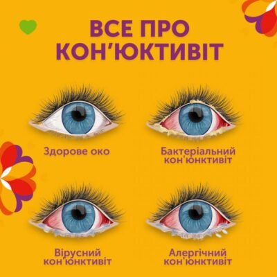 Чим промивати очі при кон’юнктивіті: ефективні засоби та поради Чим промивати очі при кон’юнктивіті: ефективні засоби та поради