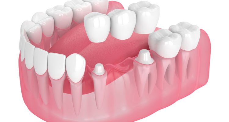Чи можна ставити коронку на живий зуб: важливі аспекти та поради