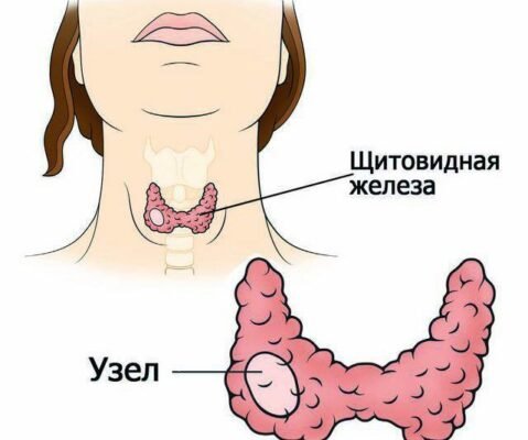 Дифузно-вогнищеві зміни щитовидної залози: симптоми та лікування